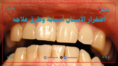 اصفرار الأسنان أسبابة وطرق علاجه