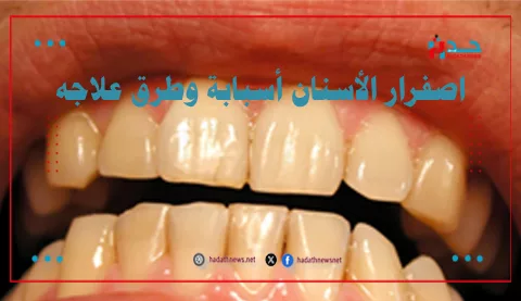 اصفرار الأسنان أسبابة وطرق علاجه