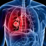 ثورة جديدة في علاج السرطان