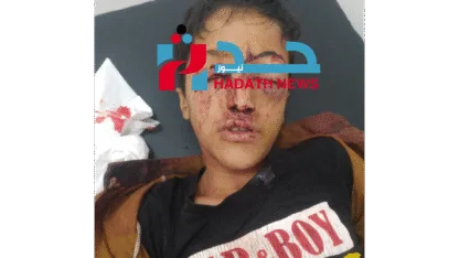 مراسل" حدث نيوز" في تعز: إصابة طفل برصاص قناص حوثي
