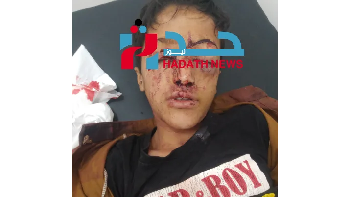مراسل” حدث نيوز” في تعز: إصابة طفل برصاص قناص حوثي