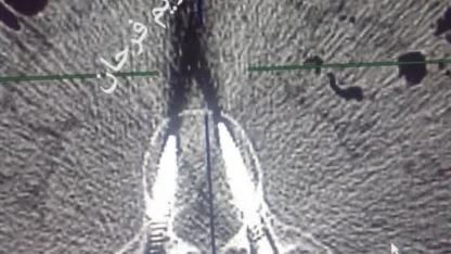 الجرّاح الشرعبي: لسنا بحاجة لرفع مسامير العمود الفقري إلا في حالة القيح